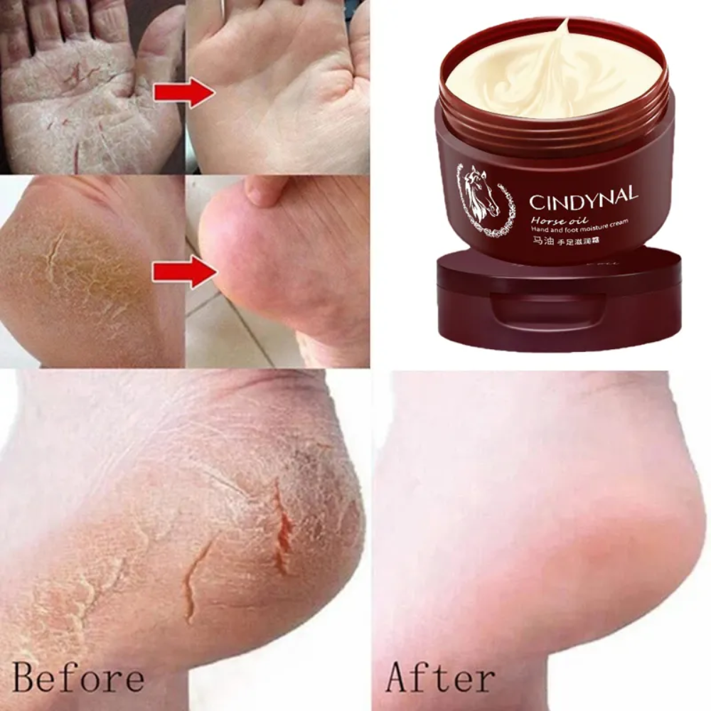 Anti-Fungal Foot Repair Cream – Cracked Heel & Dead Skin Care